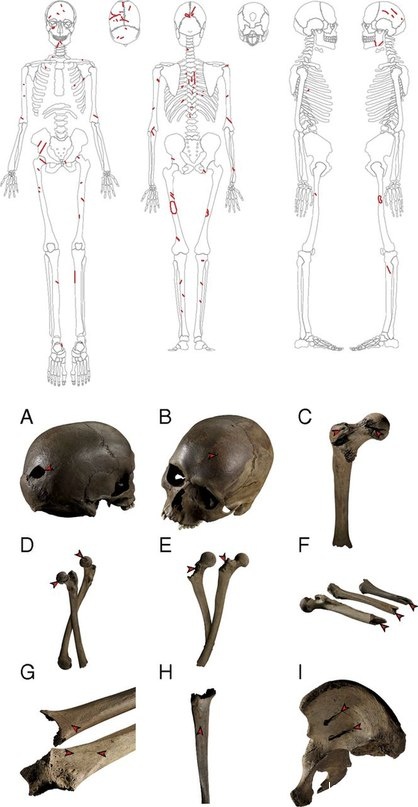 (Upper) Distribution of unhealed trauma. (Lower) Examples of trauma and taphonomic traces. (A) Sharp force trauma to the back of the cranium. (B) Penetrating trauma on the frontal bone. (C) Sharp force trauma on the posterior part of a left femur. (D) Punctures on the femoral heads, reflecting scavenging animals. (E) Furrows on the proximal joint of two femora, reflecting scavenging animals. (F) Spiral fracture on three femora, reflecting bone breakage by larger carnivores. (G) Sharp force trauma on the posterior surface of two femora. (H) Sharp force trauma on the proximal lateral part of a left tibia. (I) Parallel grooves on the iliac fossa of a right os coxa. Photos courtesy of Museum Skanderborg and graphics courtesy of Casper S. Andersen (Aarhus University, H?jbjerg, Denmark).